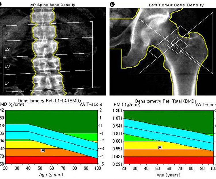 Bone Density DEXA Scan – Crown Valley Imaging